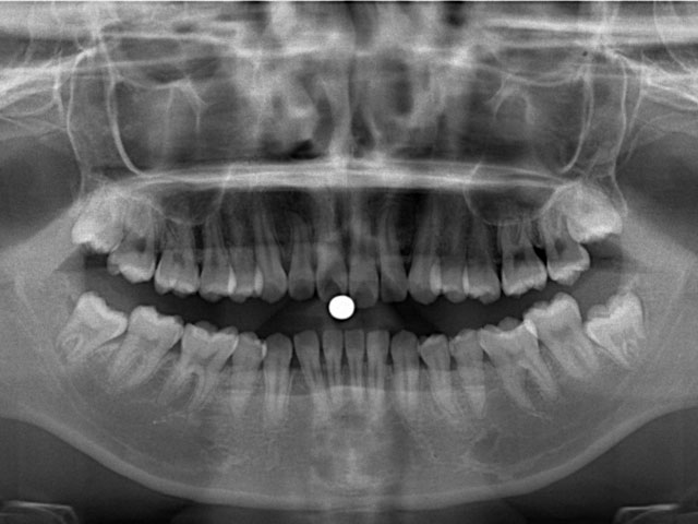 30本以上の歯が写っているレントゲン写真